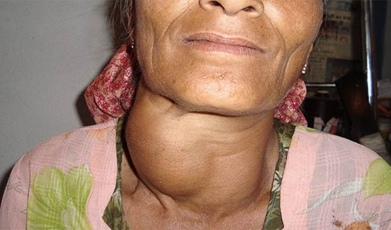 Being deficient in iodine can cause goiter (which is when your neck swells up). It can also cause stunted growth.
