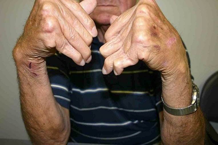old man with arthritis